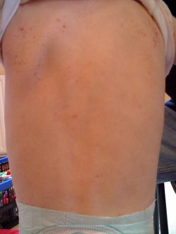 eczema after homeopathy