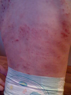 eczema before homeopathy