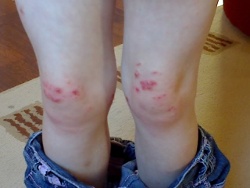 eczema after homeopathy