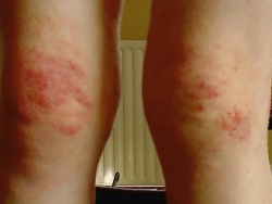 eczema before homeopathy